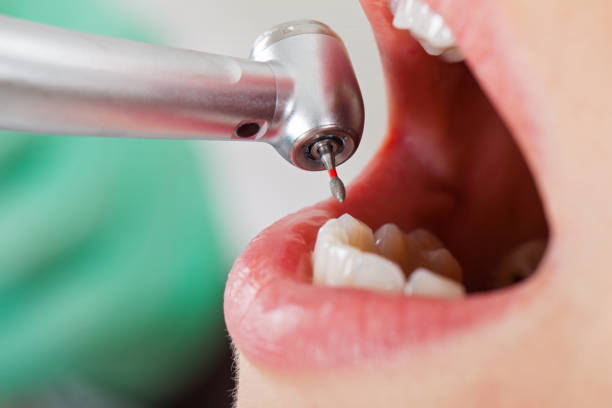 Best Emergency Root Canal Treatment in Marlboro Village, MD